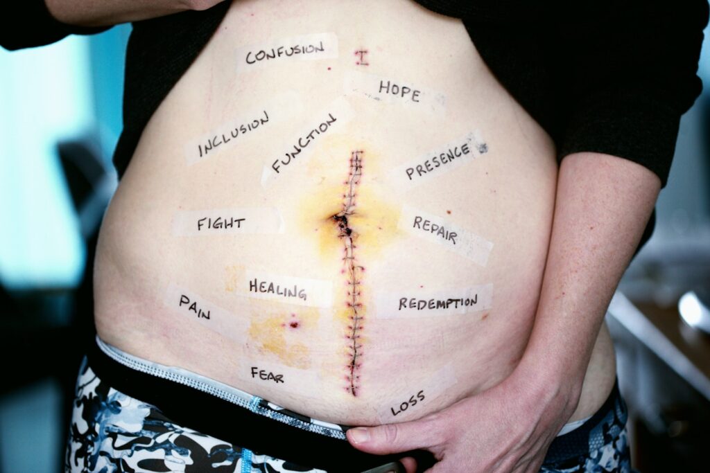 We did an empowering photo of her scar today with words taped around the scar. These words are her words to own. She chose each word. We can empathize, but we will never feel what she feels, we can imagine, but this is her pain, her recovery, her healing journey. She had right hemicolectomy surgery to remove a bit of small intestine, appendix, cecum, a huge mass they found in her cecum, her ascending colon, and a bit of her transverse colon. She has suffered from Crohn’s disease for almost 10 years.